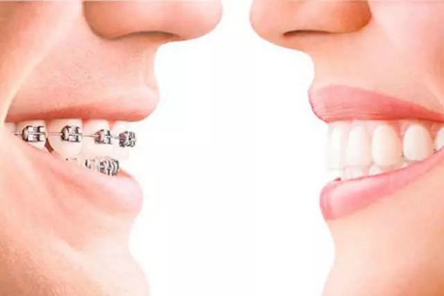 Imagem do artigo - Invisalign ou aparelho fixo? 