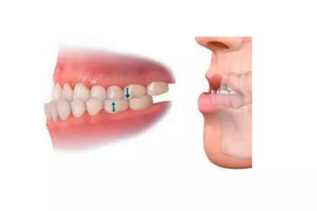 Imagem do artigo - É possível tratar mordida cruzada com invisalign 