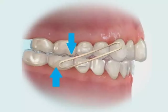 Imagem do artigo - Para que servem os elasticos no Invisalign 