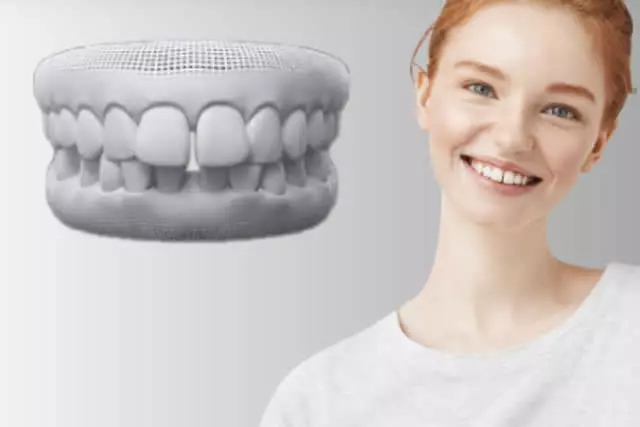 Imagem do artigo - É possivel tratar diastema com Invisalign 