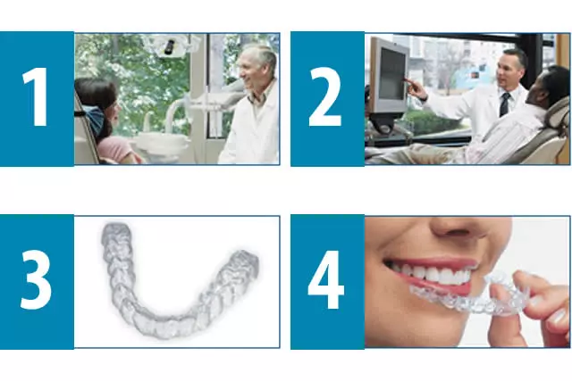 Imagem do artigo - Quais são os passos para o tratamento com alinhadores invisalign? 