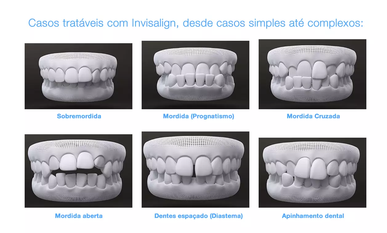 Imagem do artigo - Por que o invisalign é capaz de tratar casos complexos 