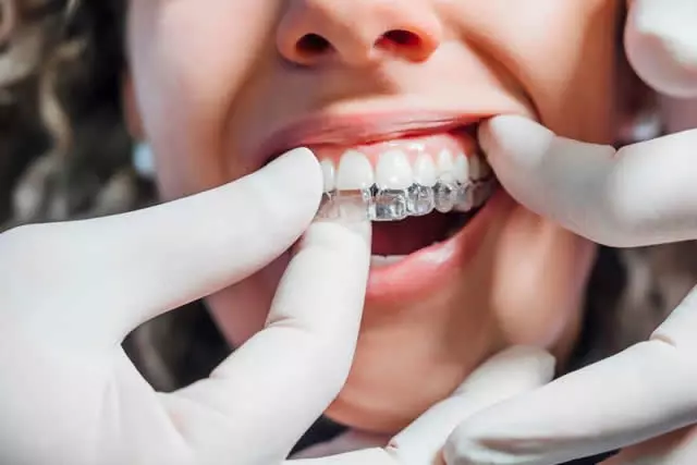 Imagem do artigo - como tirar o invisalign