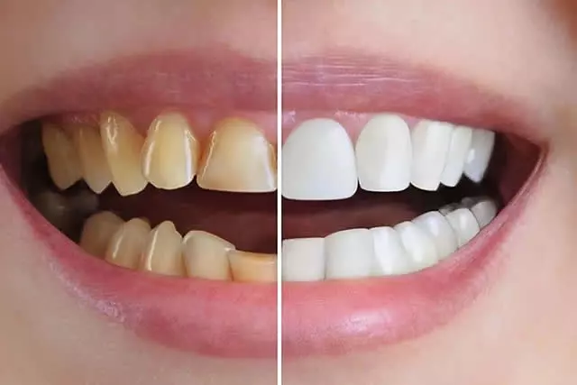 imagem de um implante dentário.