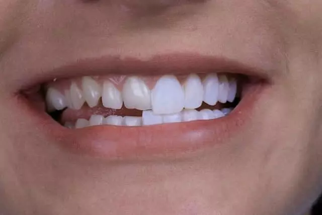 Imagem do artigo - Como fica o dente depois da lente de contato dental? 