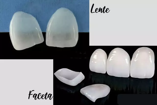 Diferença entre facetas e lentes de contato dental