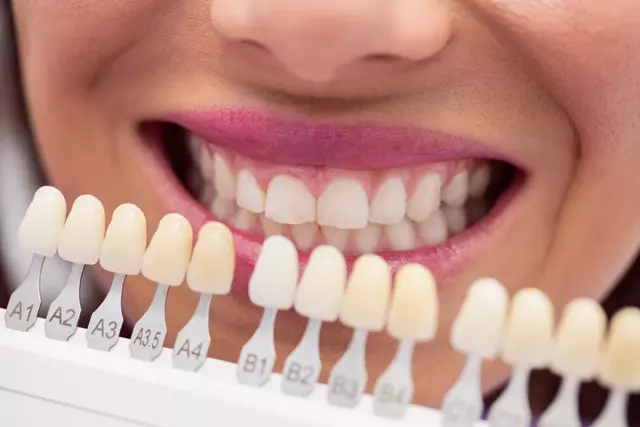 imagem do artigo - Resina para dentes: como escolher as cores?