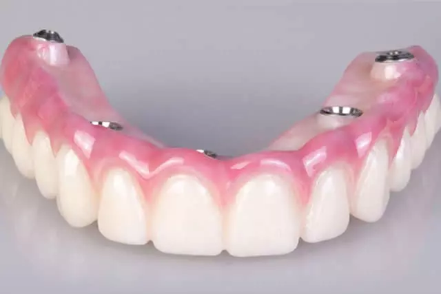 imagem de um protocolo superior dentário.