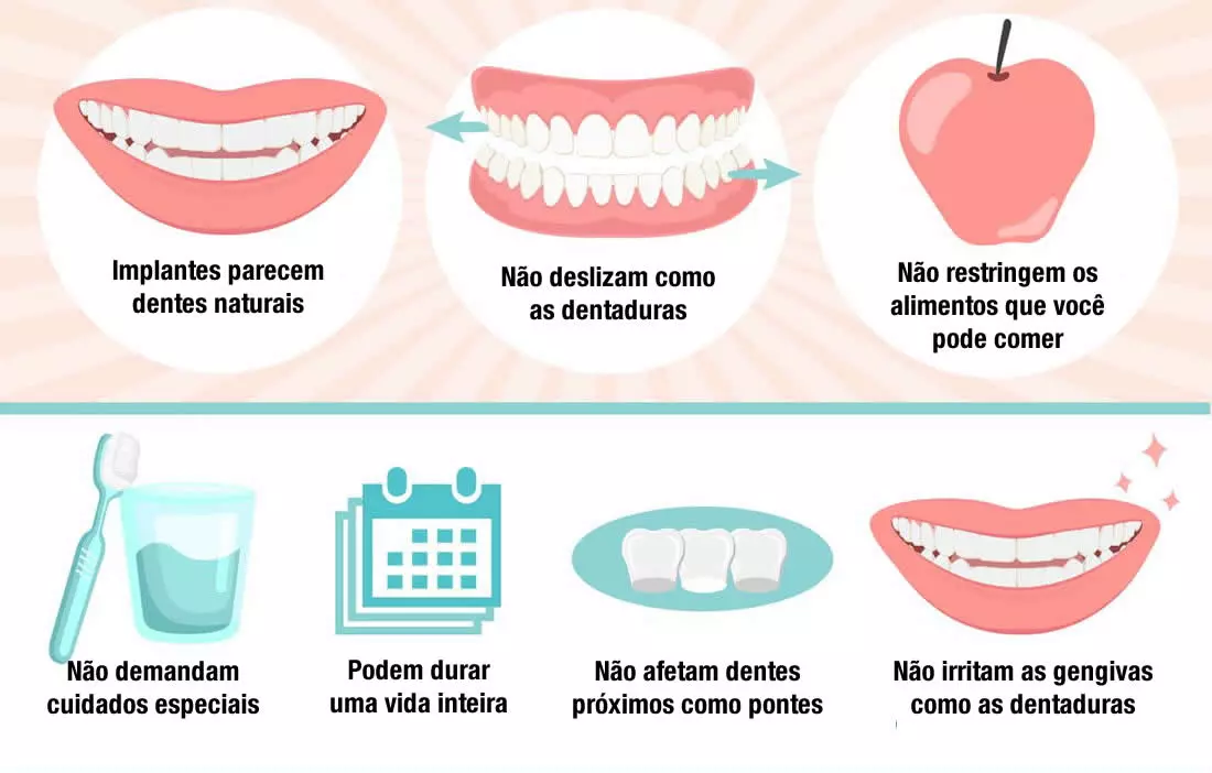 Benefícios de implantes dentários