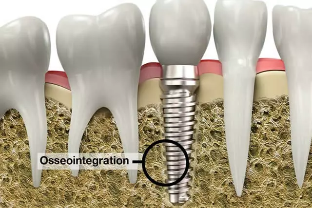 Osseointegração descubra como funciona esse implante