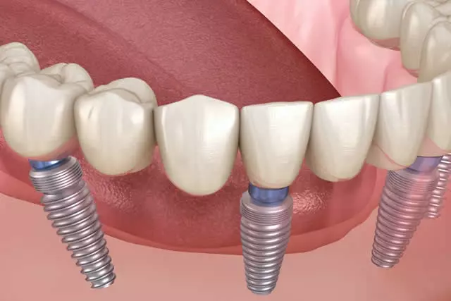 Entenda como é feito um protocolo sobre implantes