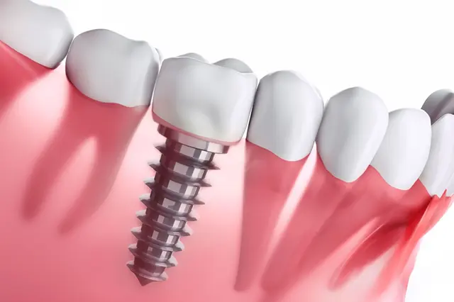 Implantes Dentários: Diga Adeus à Perda Dentária e Reconquiste sua Qualidade de Vida