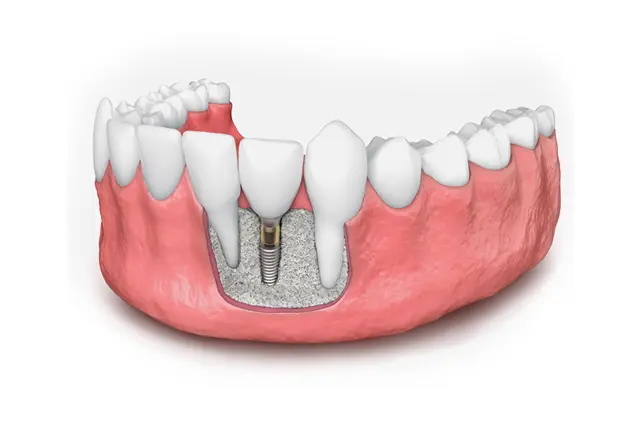 Imagem do artigo - Enxerto ósseo para implante dentário quando ele é necessário