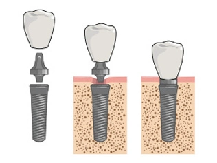 imagem de um implante dental.