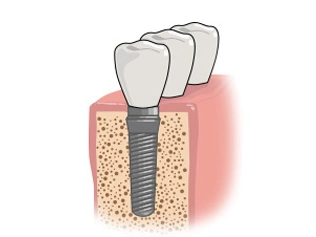 imagem de um implante dental.