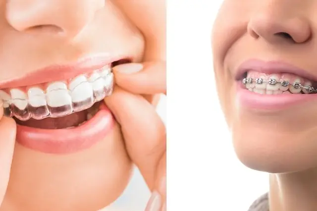 Imagem do artigo - Invisalign Perdizes: Sorriso Perfeito Sem Aparelho Metálico 