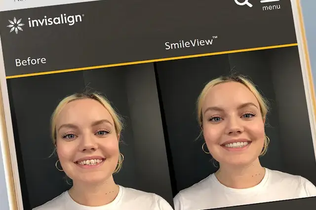 Imagem do artigo - Invisalign: Dentes Alinhados em Menos Tempo 