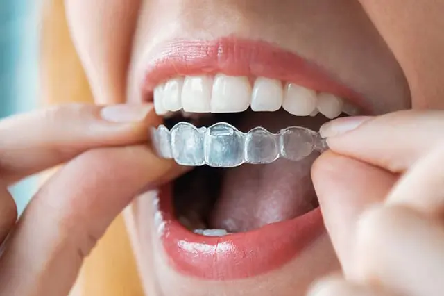 Imagem do artigo - Invisalign: Sorriso Perfeito sem Aparelho Fixo! Transforme seu Sorriso 