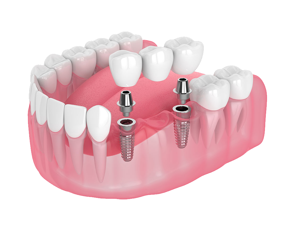 Imagem da arcada dentaria com os pinos de implantes